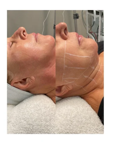 Paciente de estética deitada antes e depois do procedimento