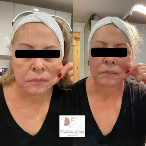 Paciente de estética demonstrando a elasticidade da pele antes e depois do procedimento